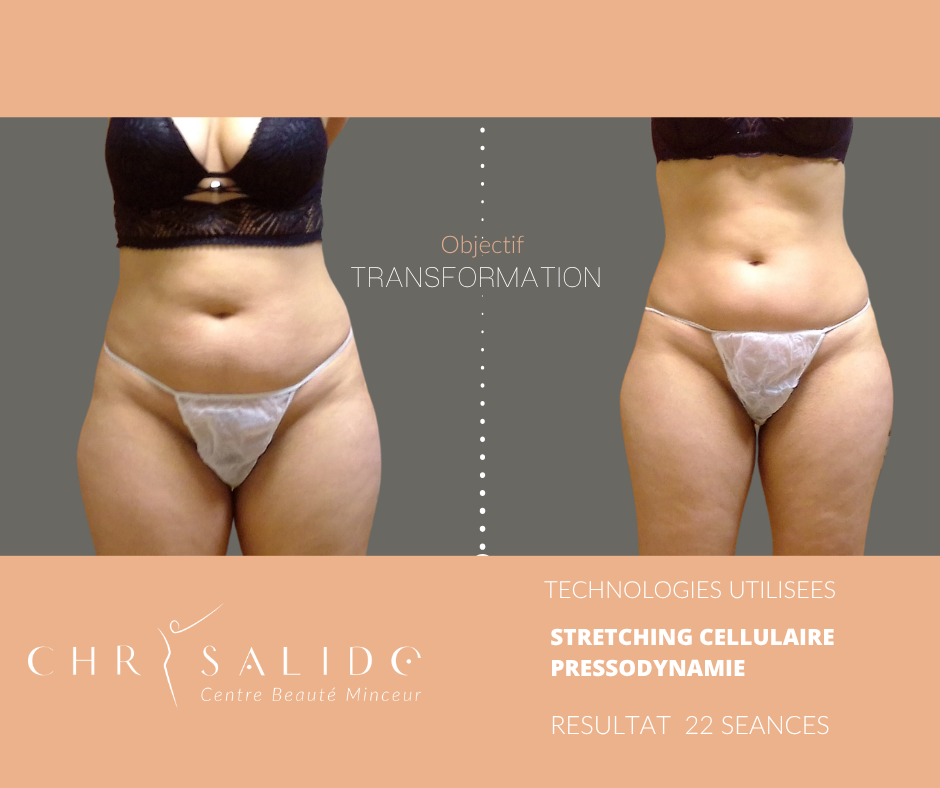 Transformation de face après 22 séances de stretching cellulaire et pressodynamie