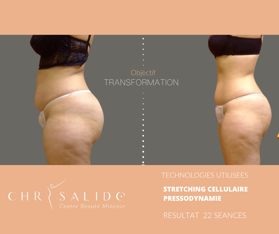 Transformation de profil après 22 séances de stretching cellulaire et pressodynamie